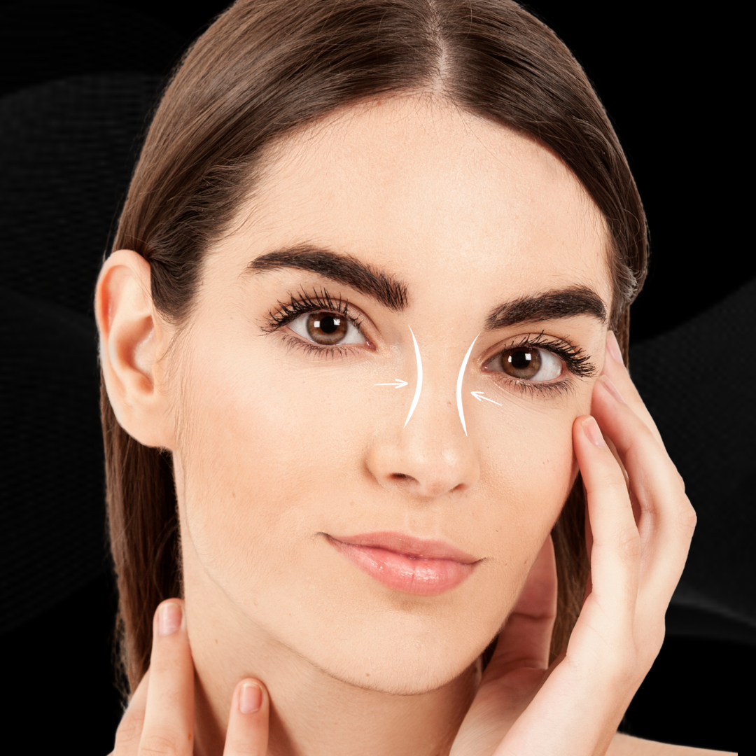 rinoplastia (2)