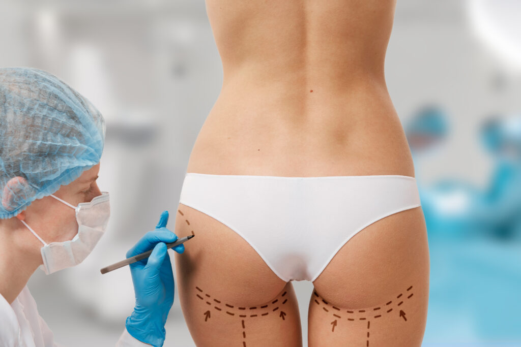 Drawing lines on a Caucasian woman's abdomen as marks for abdominal cellulite cosmetic correction surgery. Operation in the background